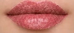 Healing stage 4, days 4–5: lips begin to peel